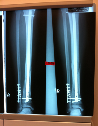 X-ray of my right leg